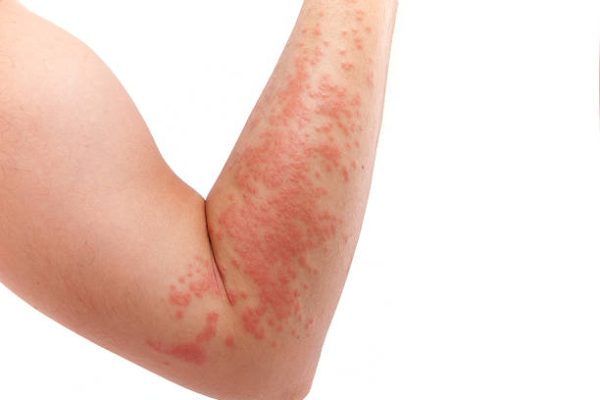 Arm covered in a skin allergy,hives