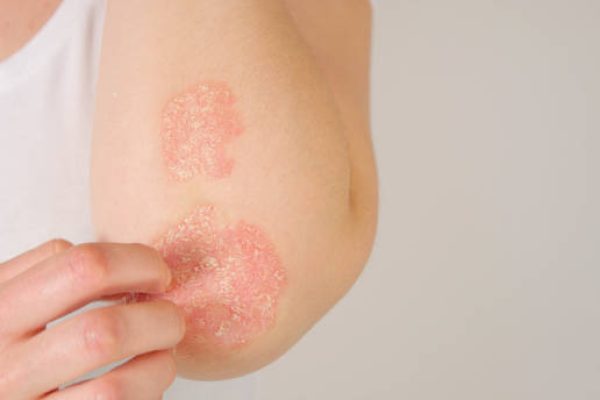 CLOSE UP: Unrecognizable young woman suffering from autoimmune incurable dermatological skin disease called psoriasis. Female gently scratching red, inflamed, scaly rash on elbows. Psoriatic arthritis